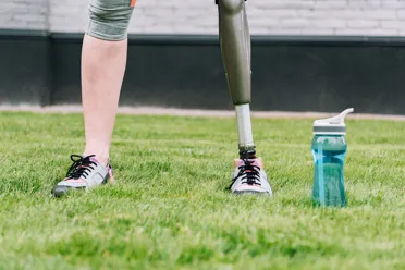 Amputeret ben erstattet med en protese
