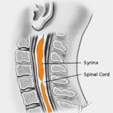 Syringomyeli